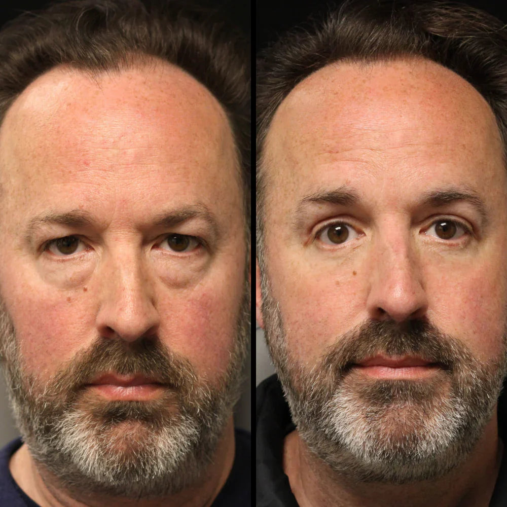 Reparador de bolsas y ojeras Serena™