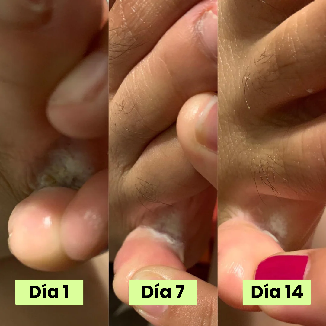 Serena® Jabón eliminador de hongos