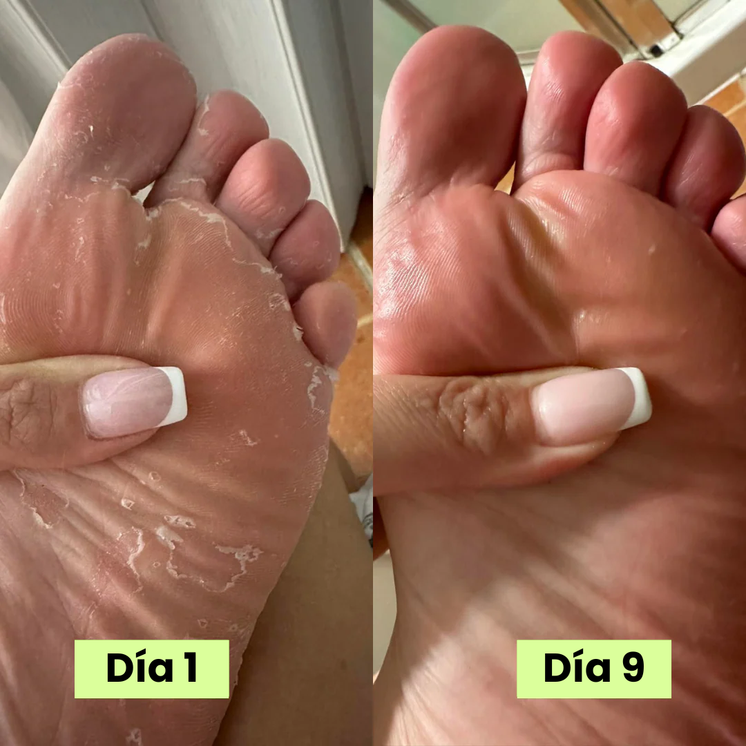 Serena® Jabón eliminador de hongos