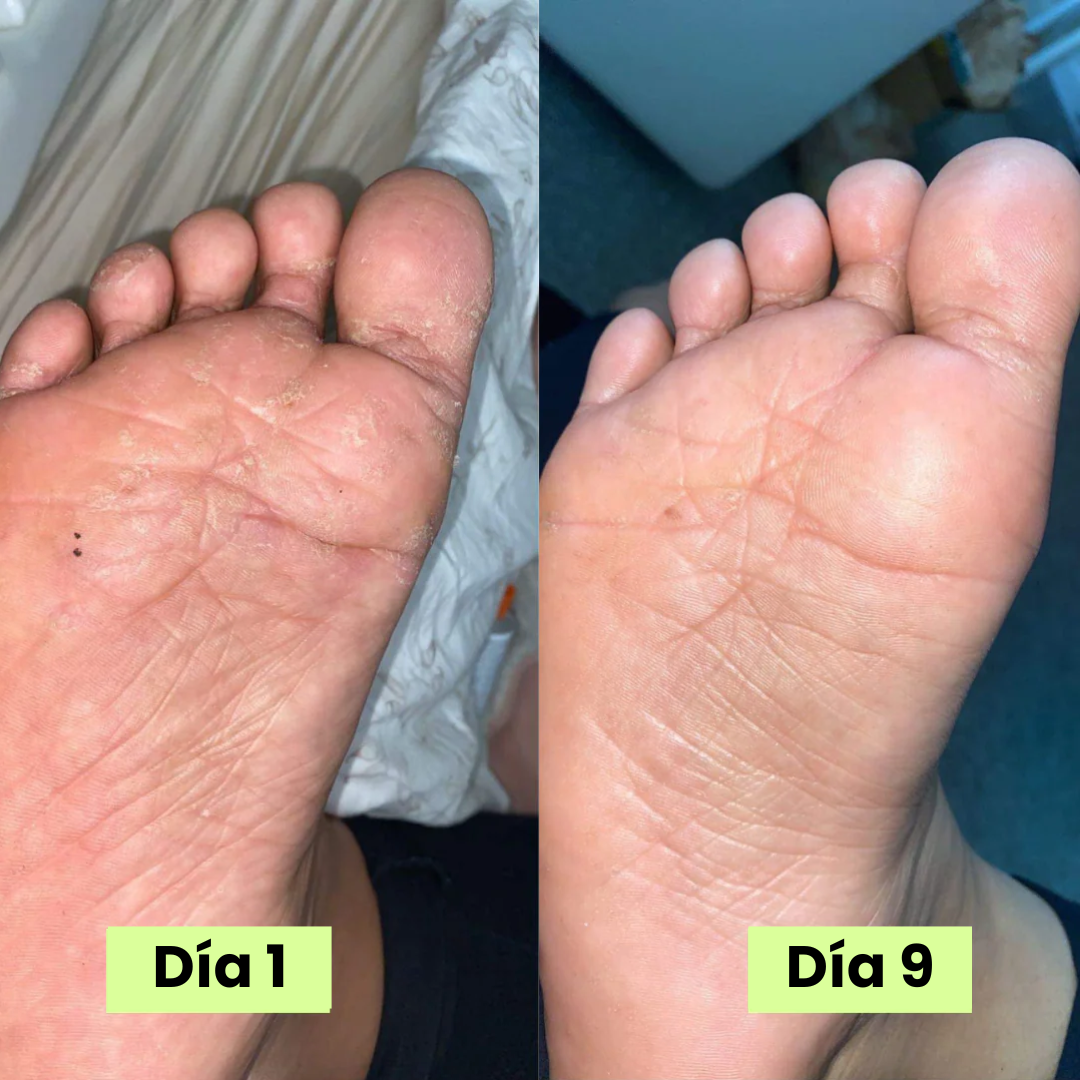 Serena® Jabón eliminador de hongos