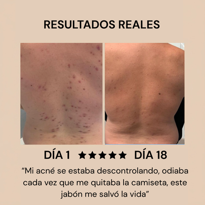 Jabón Anti Acné Serena™